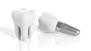Redondo Beach Dental Implants implant 300x169