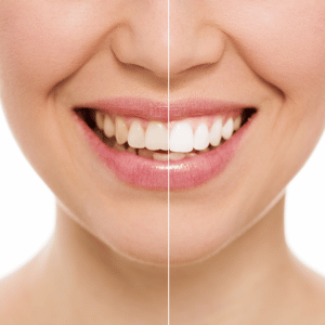 Torrance Teeth Cleaning & Whitening twhitening 300x300