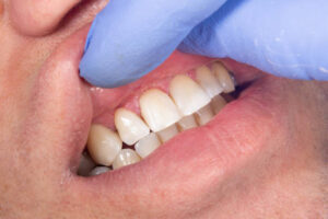 Torrance Periodontal Maintenance periodontal 1 300x200