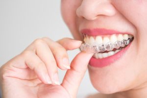 Invisalign: The Clear Choice for Straighter Teeth in Torrance, CA Torrance images invisalign 1 300x200